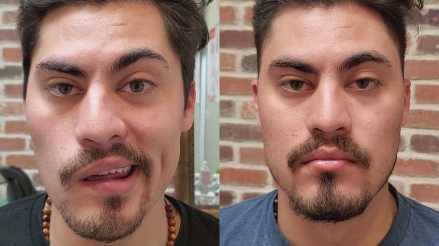 Case#3 Bell's Palsy